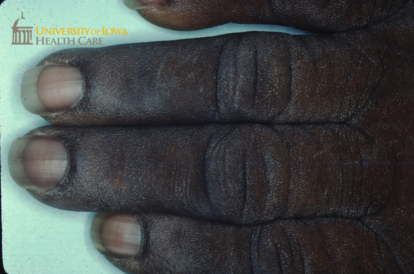 Hyperpigmented velvety plaques on the dorsal fingers. (click images for higher resolution).